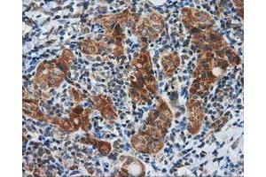 Immunohistochemical staining of paraffin-embedded Carcinoma of liver tissue using anti-SIL1 mouse monoclonal antibody. (SIL1 anticorps)