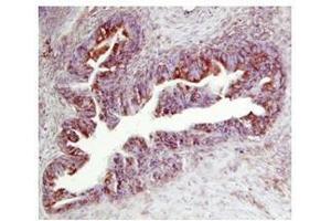 TIMP2 in human ovarian cancer was detected using HRP/AEC red color stain