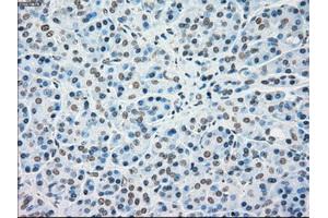 Immunohistochemical staining of paraffin-embedded Carcinoma of kidney tissue using anti-MAP2K4mouse monoclonal antibody.