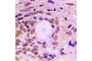 Immunohistochemical analysis of Cyclin F staining in human breast cancer formalin fixed paraffin embedded tissue section.