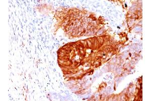 Formalin-fixed, paraffin-embedded human Colon Carcinoma stained with ALDH1A1 Mouse Monoclonal Antibody (ALDH1A1/1381). (ALDH1A1 anticorps  (AA 315-434))