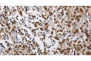 Immunohistochemistry of paraffin-embedded Human esophagus cancer tissue using CMTM2 Polyclonal Antibody at dilution 1:60 (CMTM2 anticorps)