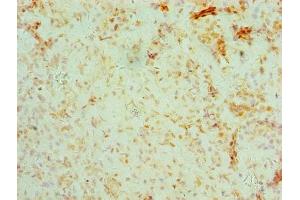Immunohistochemistry of paraffin-embedded human ovarian cancer using ABIN7158679 at dilution of 1:100