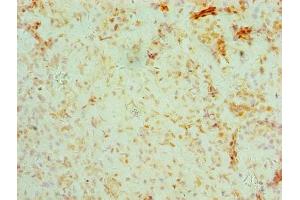 Immunohistochemistry of paraffin-embedded human ovarian cancer using ABIN7158679 at dilution of 1:100 (BRCC3 anticorps  (AA 14-316))