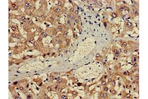 Immunohistochemistry of paraffin-embedded human liver cancer using ABIN7142600 at dilution of 1:100 (ALAS1 anticorps  (AA 57-285))