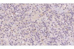 ABIN6273120 at 1/100 staining Human lymph cancer tissue by IHC-P. (HBXIP anticorps  (Internal Region))