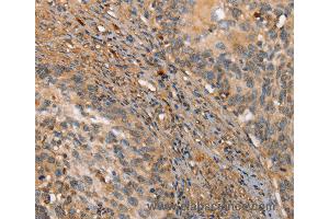 Immunohistochemistry of Human ovarian cancer using HK3 Polyclonal Antibody at dilution of 1:40 (HK3 anticorps)