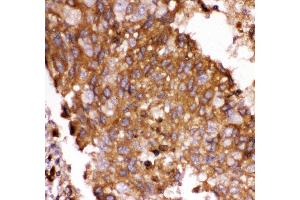 Anti- FOXO3A antibody,IHC(P) IHC(P): Human Lung Cancer Tissue