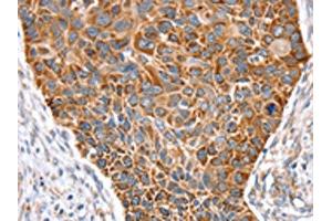 The image on the left is immunohistochemistry of paraffin-embedded Human esophagus cancer tissue using ABIN7131122(SNX11 Antibody) at dilution 1/30, on the right is treated with fusion protein. (SNX11 anticorps)