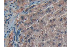 Detection of CD55 in Human Liver cancer Tissue using Polyclonal Antibody to Cluster Of Differentiation 55 (CD55)