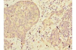 Immunohistochemistry of paraffin-embedded human gastric cancer using ABIN7160145 at dilution of 1:100