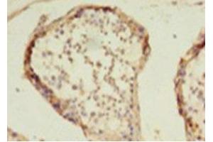 Immunohistochemistry of paraffin-embedded human colon cancer using ABIN7155301 at dilution of 1: 100