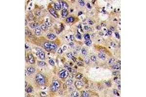 IHC analysis of FFPE human hepatocarcinoma stained with HDAC6 antibody (HDAC6 anticorps  (AA 1182-1215))