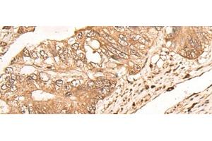 Immunohistochemistry of paraffin-embedded Human colorectal cancer tissue using MAGEA1 Polyclonal Antibody at dilution of 1:65(x200) (MAGEA1 anticorps)