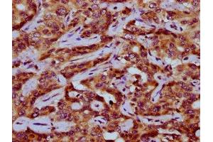 IHC image of ABIN7162965 diluted at 1:200 and staining in paraffin-embedded human liver cancer performed on a Leica BondTM system.