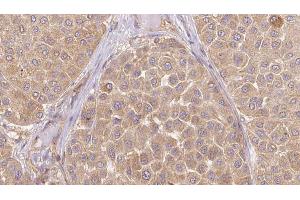 ABIN6273647 at 1/100 staining Human Melanoma tissue by IHC-P. (IGFL1 anticorps)