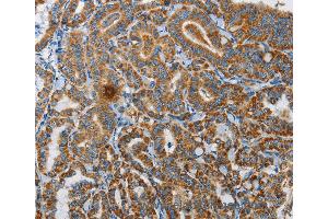 Immunohistochemistry of Human thyroid cancer using UPF1 Polyclonal Antibody at dilution of 1:35 (RENT1/UPF1 anticorps)