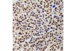 Immunohistochemistry of paraffin-embedded mouse tumor using PHIP antibody (ABIN6129078, ABIN6145556, ABIN6145557 and ABIN6223036) at dilution of 1:100 (40x lens).