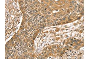 The image on the left is immunohistochemistry of paraffin-embedded Human esophagus cancer tissue using ABIN7192541(SLIT1 Antibody) at dilution 1/35, on the right is treated with synthetic peptide. (SLIT1 anticorps)