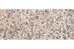 Immunohistochemistry of paraffin-embedded Human liver cancer tissue using HLA-DRA Polyclonal Antibody at dilution of 1:30(x200)