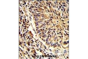 Formalin-fixed and paraffin-embedded human lung carcinoma reacted with AD Antibody (C-term), which was peroxidase-conjugated to the secondary antibody, followed by DAB staining. (ADAM9 anticorps  (C-Term))