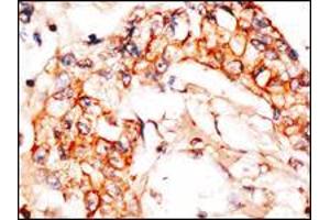 Formalin-fixed and paraffin-embedded human breast carcinoma reacted with anti-APPBP1 Antibody , which was peroxidase-conjugated to the secondary antibody, followed by DAB staining.