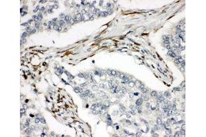 IHC-P: TRAIL R2 antibody testing of human lung cancer tissue