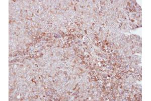 IHC-P Image Immunohistochemical analysis of paraffin-embedded DLD1 xenograft, using MMP12, antibody at 1:500 dilution. (MMP12 anticorps)
