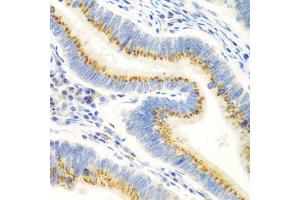 Immunohistochemistry of paraffin-embedded human colon carcinoma using UBIAD1 antibody.