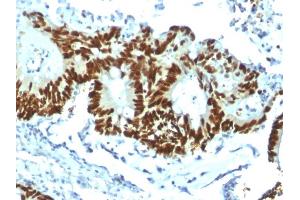 Formalin-fixed, paraffin-embedded human Colon Carcinoma stained with p53 Recombinant Rabbit Monoclonal Antibody (TP53/1799R). (Recombinant p53 anticorps)