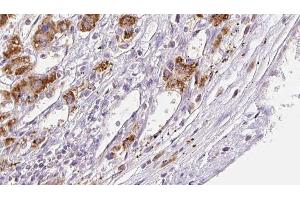 ABIN6272308 at 1/100 staining Human liver cancer tissue by IHC-P.