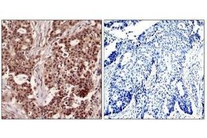 Immunohistochemical analysis of paraffin-embedded human breast carcinoma tissue using NFkB-p105(Phospho-Ser927) Antibody(left) or the same antibody preincubated with blocking peptide(right). (NFKB1 anticorps  (pSer927))
