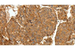 Immunohistochemistry of paraffin-embedded Human lung cancer tissue using COL4A1 Polyclonal Antibody at dilution 1:30
