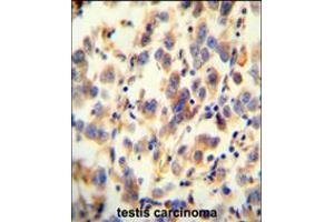 UGT3A2 antibody immunohistochemistry analysis in formalin fixed and paraffin embedded human testis carcinoma followed by peroxidase conjugation of the secondary antibody and DAB staining.