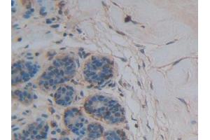 DAB staining on IHC-P; Samples: Human Breast cancer Tissue (Thrombospondin 1 anticorps  (AA 24-221))