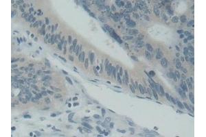 Detection of SNAP25 in Human Stomach cancer Tissue using Polyclonal Antibody to Synaptosomal Associated Protein 25 kDa (SNAP25) (SNAP25 anticorps  (AA 1-206))