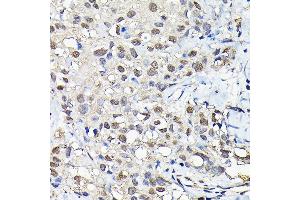 Immunohistochemistry of paraffin-embedded human breast cancer using PFKFB3 Rabbit pAb (ABIN6129841, ABIN6145485, ABIN6145487 and ABIN6222692) at dilution of 1:25 (40x lens).