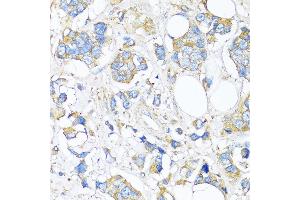 Immunohistochemistry of paraffin-embedded Human breast cancer using TIMP2 antibody (ABIN7268483) at dilution of 1:150 (40x lens). (TIMP2 anticorps  (AA 100-200))