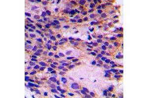 Immunohistochemical analysis of PEX7 staining in human breast cancer formalin fixed paraffin embedded tissue section.