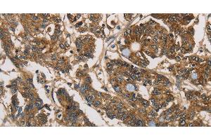 Immunohistochemistry of paraffin-embedded Human colon cancer tissue using UBE2S Polyclonal Antibody at dilution 1:40 (UBE2S anticorps)