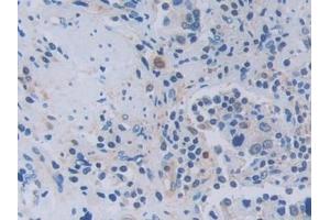 Detection of TNFSF9 in Human Prostate cancer Tissue using Polyclonal Antibody to Tumor Necrosis Factor Ligand Superfamily, Member 9 (TNFSF9)