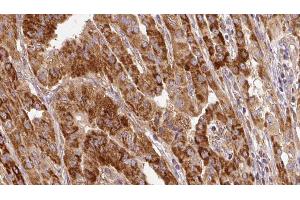 ABIN6267121 at 1/100 staining Human thyroid cancer tissue by IHC-P. (GRB10 anticorps  (pSer476))
