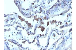 Formalin-fixed, paraffin-embedded human Lung Carcinoma stained with AMACR / p504S Rabbit Polyclonal Antibody.