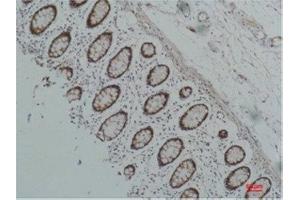Immunohistochemistry (IHC) analysis of paraffin-embedded Human Colon Carcicnoma using HSP90 alpha Mouse Monoclonal Antibody diluted at 1:200. (HSP90AA2 anticorps)