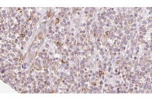 ABIN6273209 at 1/100 staining Human lymph cancer tissue by IHC-P. (SH3KBP1 anticorps  (N-Term))