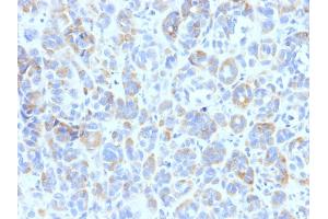 Formalin-fixed, paraffin-embedded human Melanoma stained with TYRP1 Mouse Monoclonal Antibody (TYRP1/807) (Tyrosinase-Related Protein 1 anticorps)