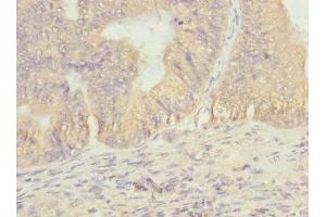 Immunohistochemistry of paraffin-embedded human prostate cancer using ABIN7172901 at dilution of 1:100