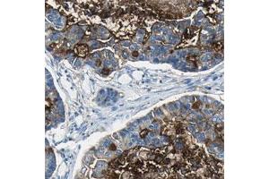 Immunohistochemical staining of human lung cancer, adenocarcinoma shows moderate cytoplasmic positivity in tumor cells. (MUC4 anticorps)