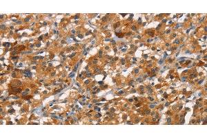 Immunohistochemistry of paraffin-embedded Human thyroid cancer tissue using CDC25B Polyclonal Antibody at dilution 1:45 (CDC25B anticorps)