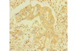 Immunohistochemistry of paraffin-embedded human pancreatic cancer using ABIN7156691 at dilution of 1:100 (IFITM5 anticorps  (AA 1-36))